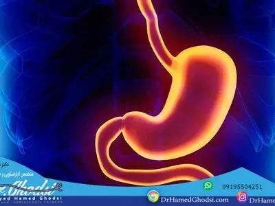 کوچک کردن معده با روشی کم خطر اما موثر