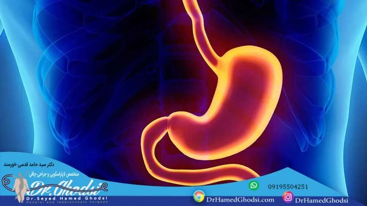 کوچک کردن معده با روشی کم خطر اما موثر