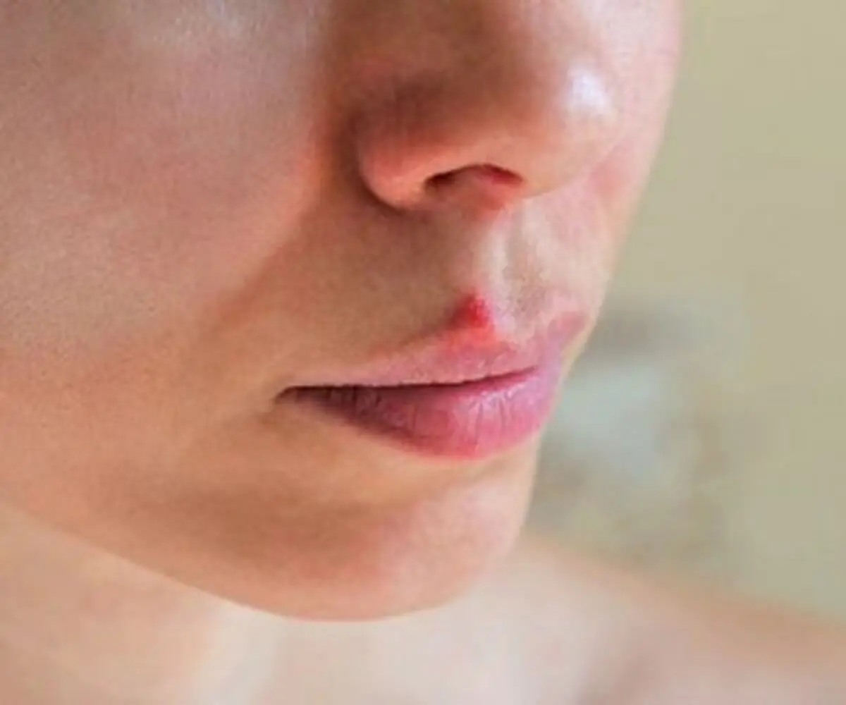 تبخال را سه دقیقه ای ناپدید کنید