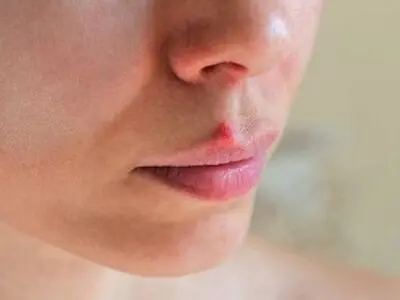 تبخال را سه دقیقه ای ناپدید کنید