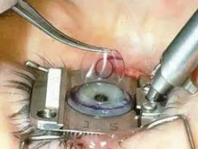 نحوه عمل لیزیک چگونه است + فیلم