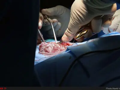 جراحی لامینکتومی توسط دکتر مهرداد اسماعیلی جراح مغز و اعصاب در بیمارستان مرکزی شیراز
