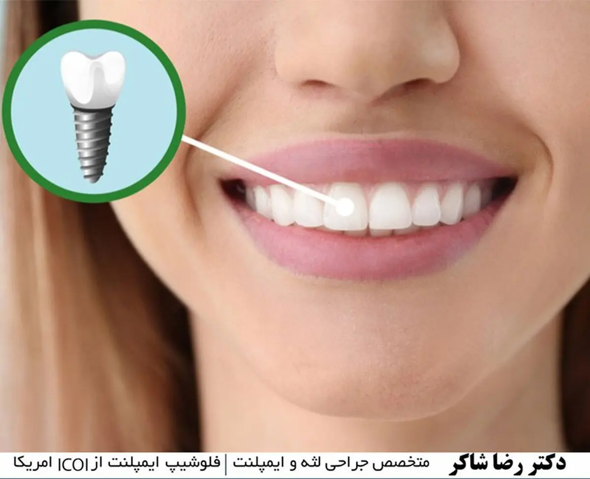 ایمپلنت دندان چیست؟ بهترین روش ایمپلنت دندان