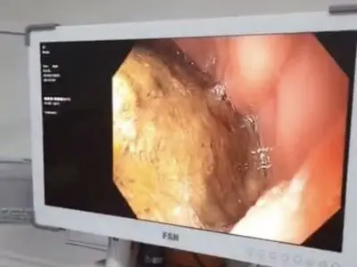 سنگ بزرگ معده بدون جراحی از بدن بیمار خارج شد 