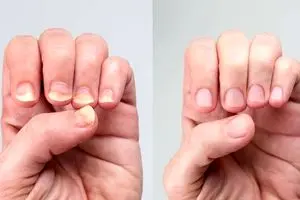 نقاط سفید روی ناخن‌ها نشانه کم‌خونی نیستند