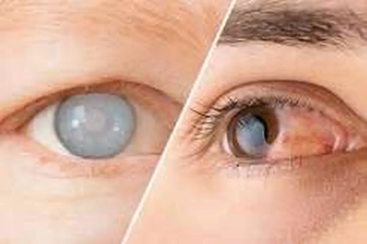 آیا می‌توان از ابتلا به آب مروارید چشم پیشگیری کرد؟ + فیلم