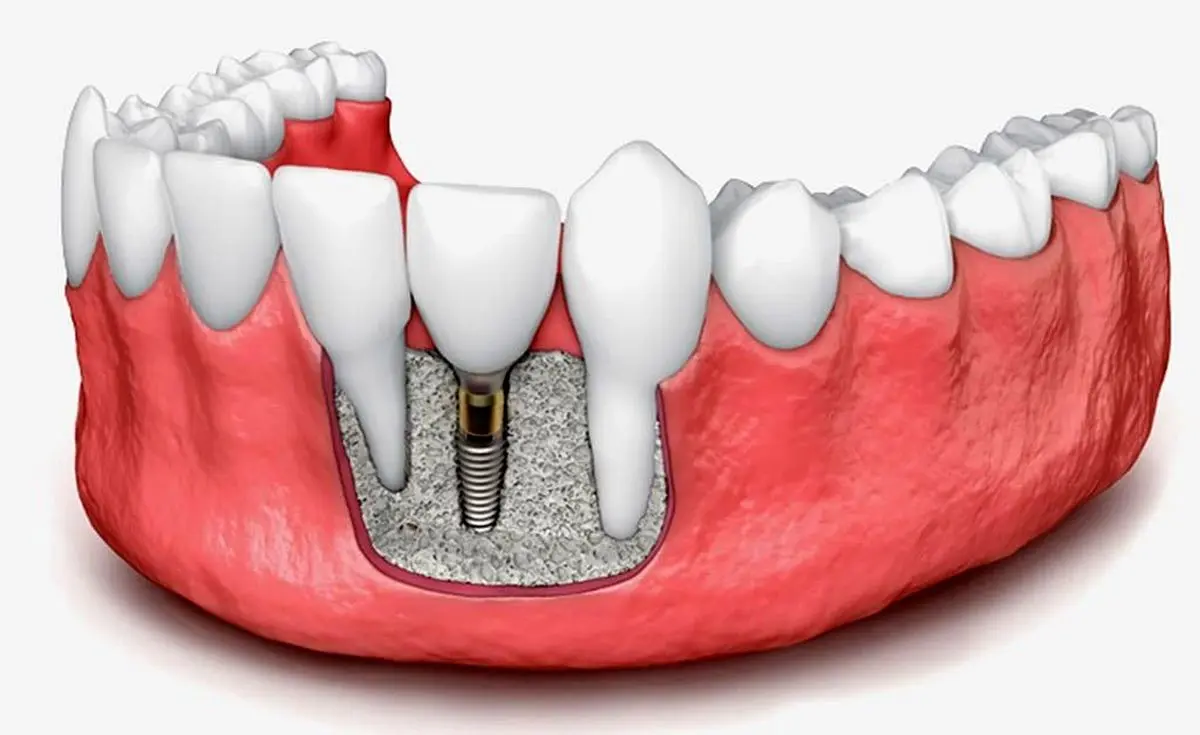 ایمپلنت دندان - بهترین روش جایگزینی دندان از دست رفته