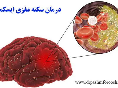 بهترین درمان سکته مغزی چیست؟