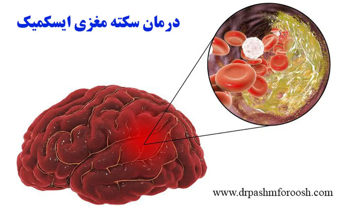 بهترین درمان سکته مغزی چیست؟