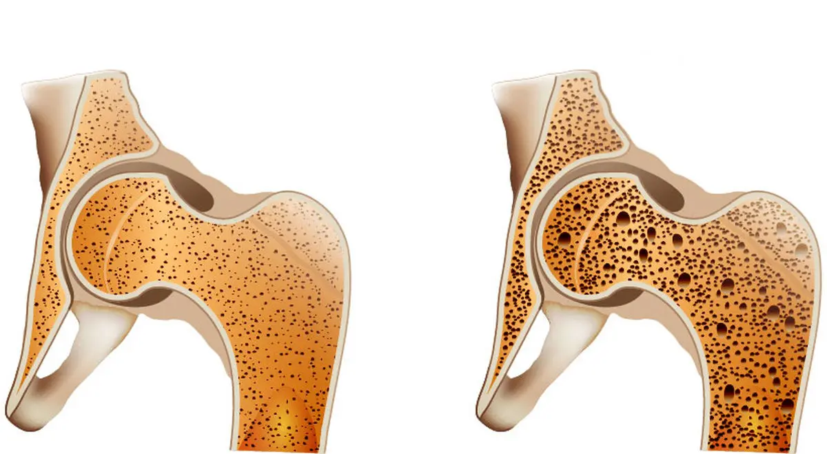 موج پوکی استخوان به آقایان رسید