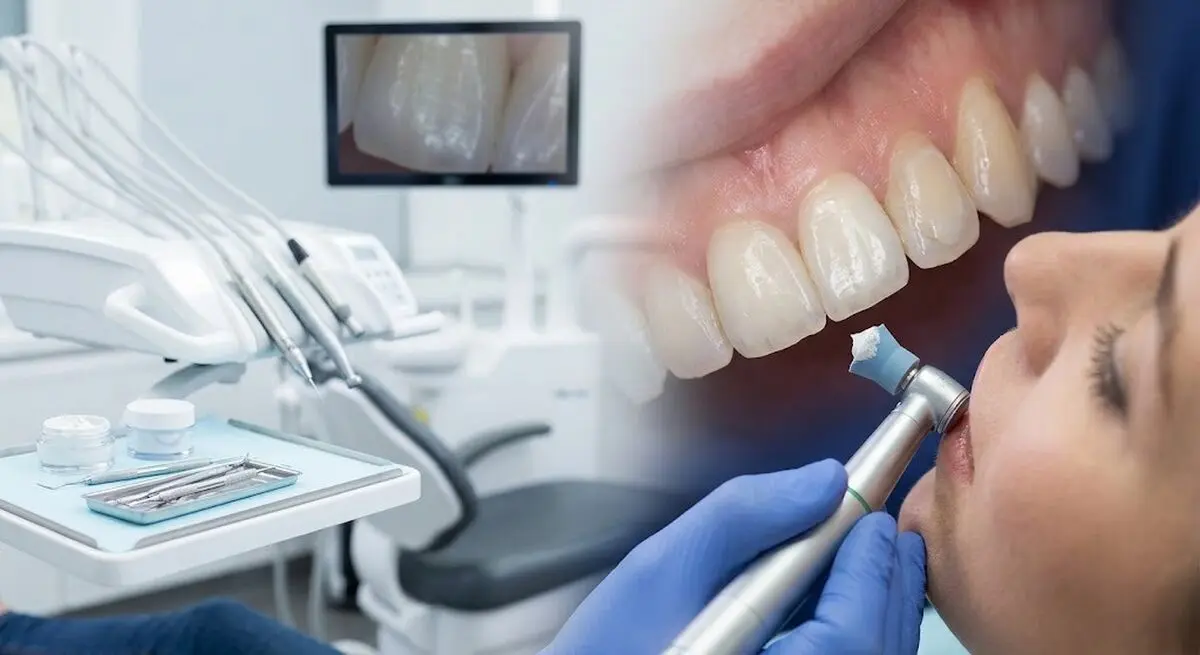 برای سفید شدن کامپوزیت دندان چه کنیم؟ 