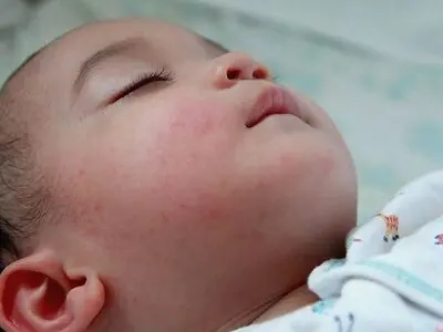 مدیریت اگزما در نوزادان