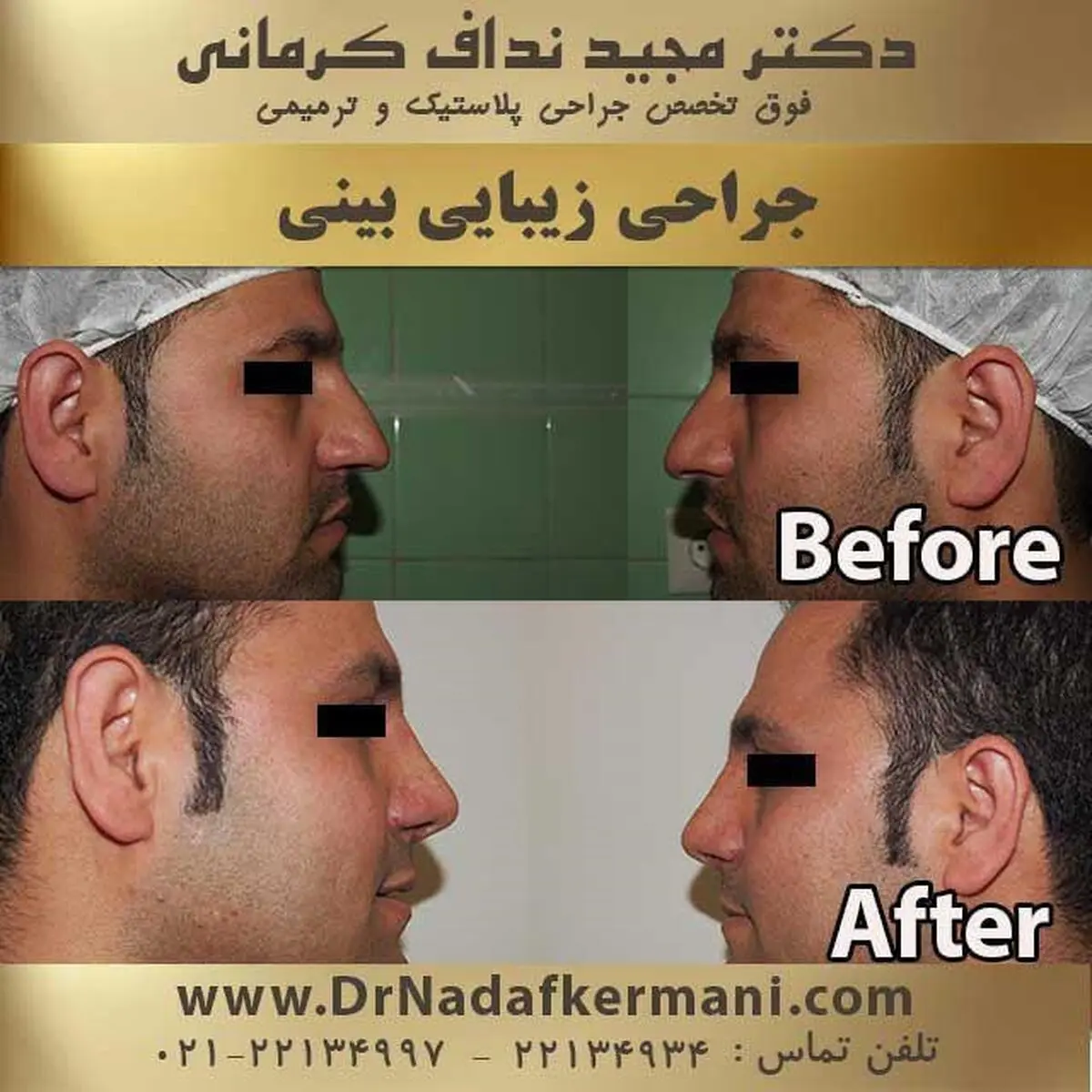انواع جراحی بینی را بشناسید