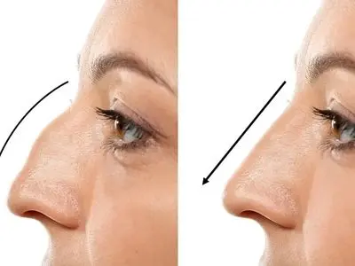 بهترین جراحی بینی در ایلام کجاست ؟