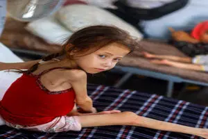 200هزار کودک در غزه از سوءتغذیه شدید رنج می‌برند