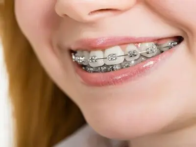 راهنمای انتخاب بین ارتودنسی ثابت، متحرک و سرامیکی