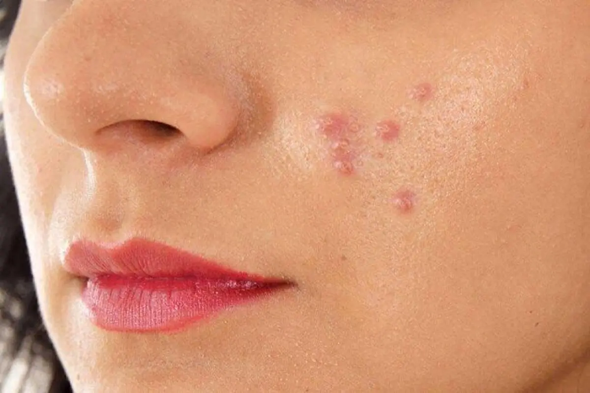 افزایش آکنه‌های پوستی با مصرف این مواد غذایی پرطرفدار