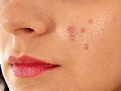 افزایش آکنه‌های پوستی با مصرف این مواد غذایی پرطرفدار