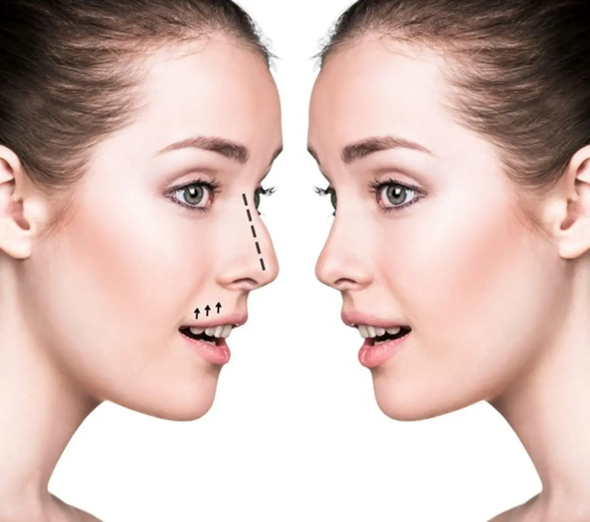 جراحی بینی در ایلام؛ راز چهره‌ای جذاب و زیبا