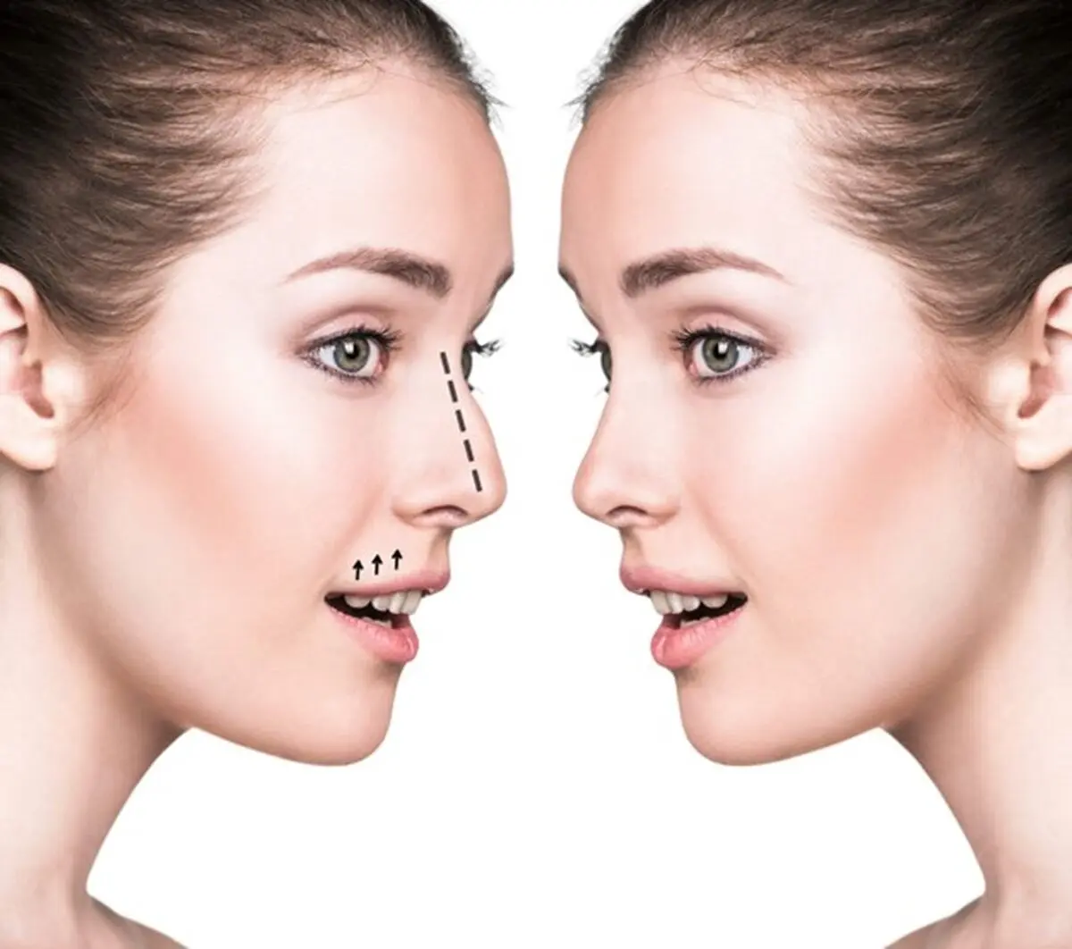 جراحی بینی در ایلام؛ راز چهره‌ای جذاب و زیبا