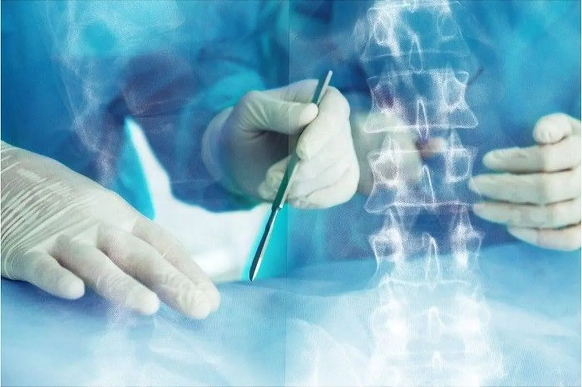 جراحی لامینکتومی دیسک کمر چگونه انجام میشود؟