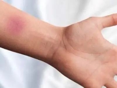 چگونه از شر کبودی‌ها خلاص شویم؟