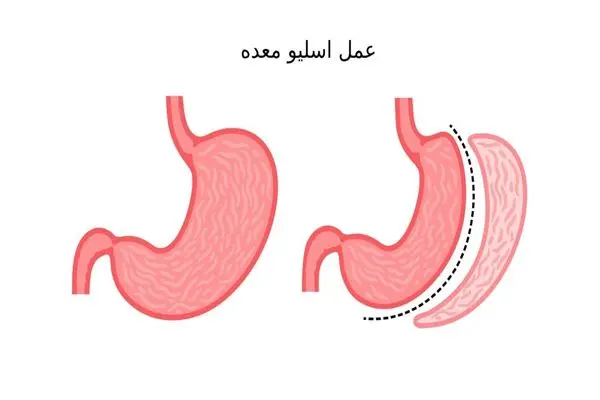 عمل اسلیو: راهی موثر برای لاغری