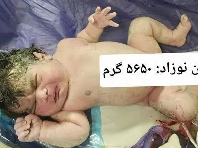 تولد نوزاد ۵ کیلو و ۶۵۰ گرمی در بیمارستان امام رضا(ع) کرمانشاه