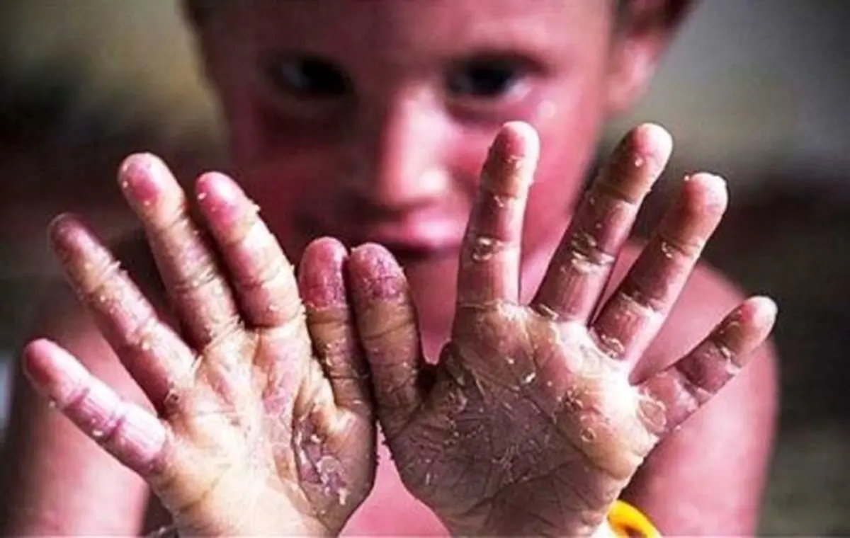 ۹۰ درصد بیماران ای‌بی نیاز به پانسمان‌های تحریمی دارند