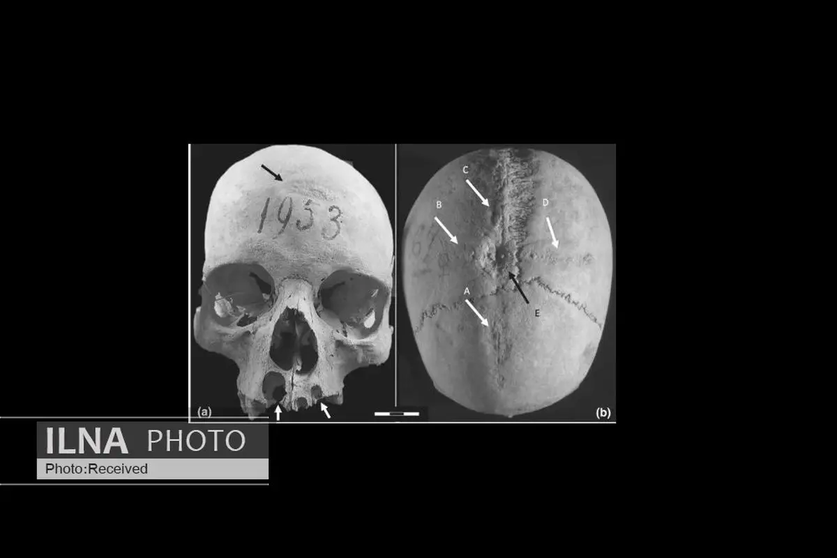 نشانه‌هایی از انجام دو عمل جراحی در جمجمه زن قرون وسطایی