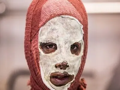 قطع انگشتان پسر ۱۶ ساله اصفهانی به دلیل ترقه‌بازی