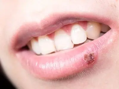چرا تبخال با استرس تشدید می‌شود؟