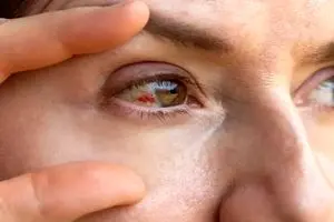 دلایل پارگی رگ خونی در چشم