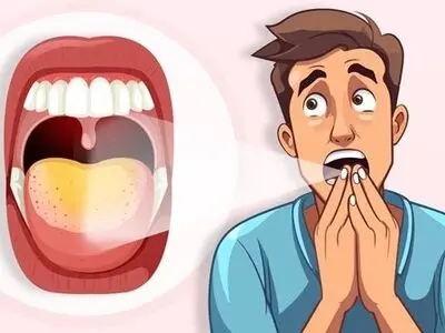 دلایل زردی زبان چیست؟ + اینفوگرافیک