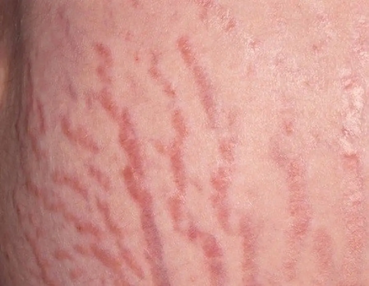 علل خارش ترک های بارداری چیست