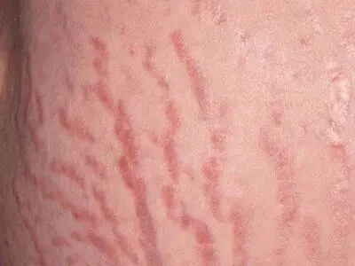 علل خارش ترک های بارداری چیست