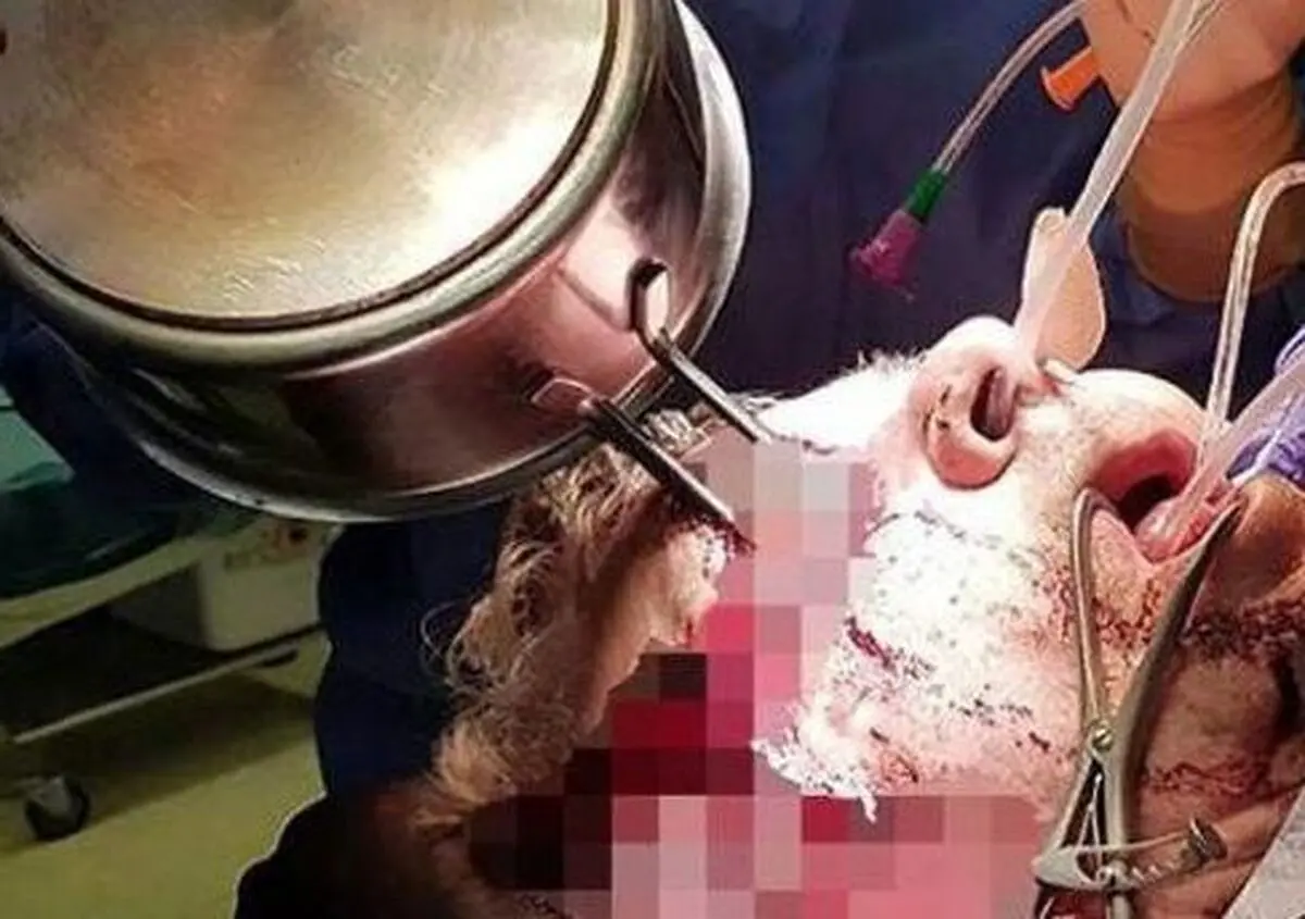 دسته ماهی تابه داخل چشم آشپز فرو رفت