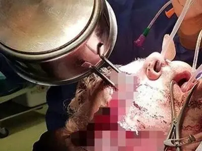 دسته ماهی تابه داخل چشم آشپز فرو رفت
