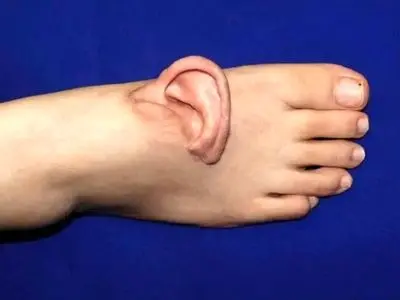  برای اولین بار گوش به پا پیوند زده شد