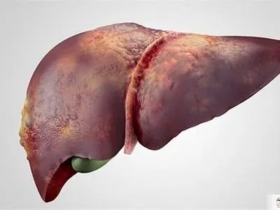 اگر می خواهید کبدتان سالم بماند این موارد را رعایت کنید