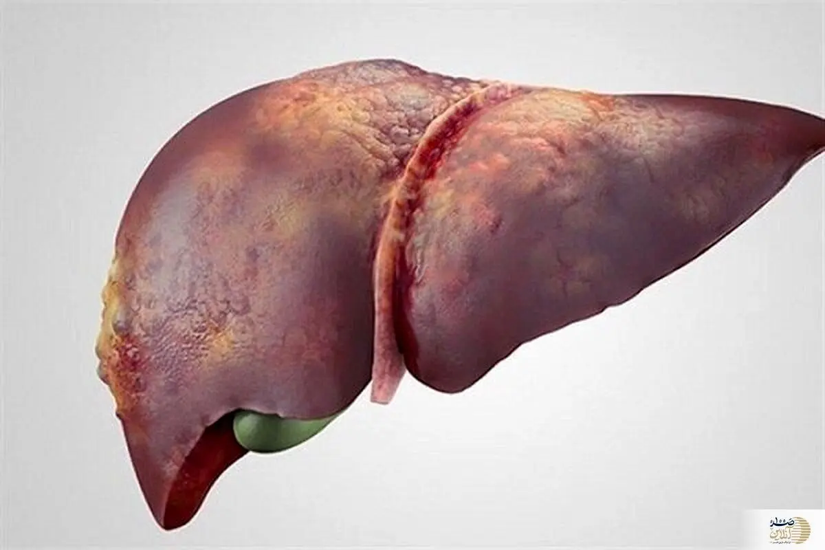 اگر می خواهید کبدتان سالم بماند این موارد را رعایت کنید