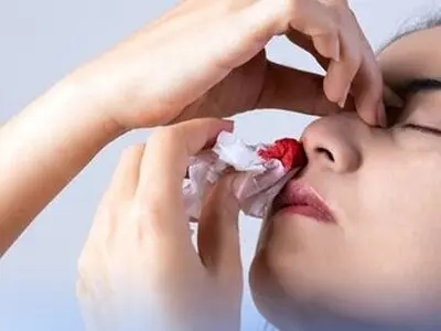چرا در تابستان خون‌ دماغ می‌شویم؟/ پیشگیری و راه درمان