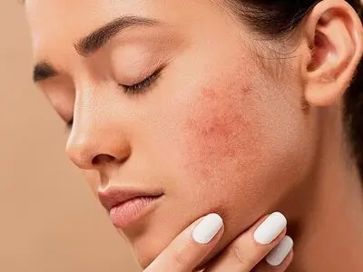 غذاهایی که باعث آکنه می‌شوند