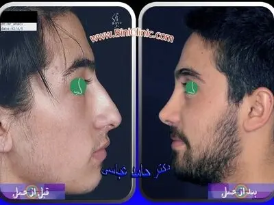 عمل بینی چیست و چگونه انجام میشود؟