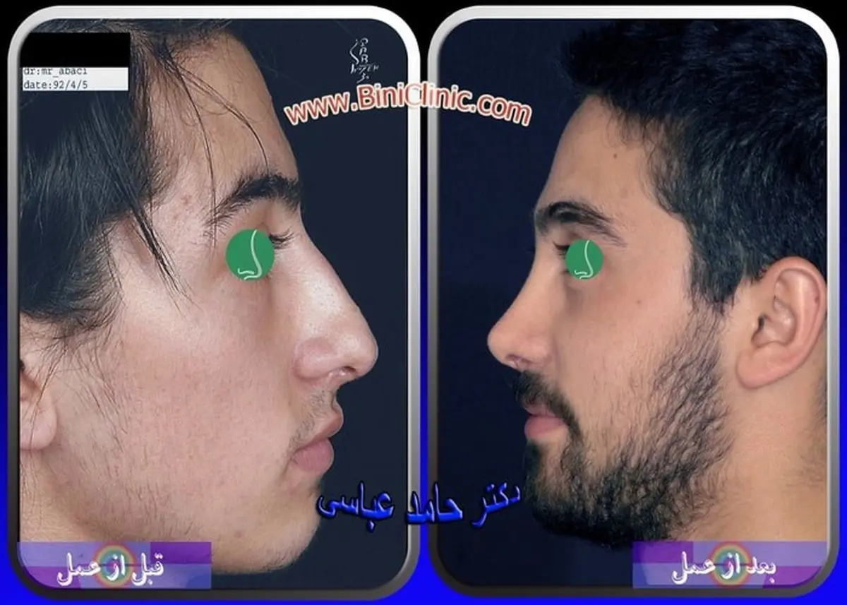 عمل بینی چیست و چگونه انجام میشود؟