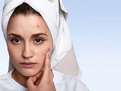 راه‌های سریع کاهش آکنه و جوش روی صورت 