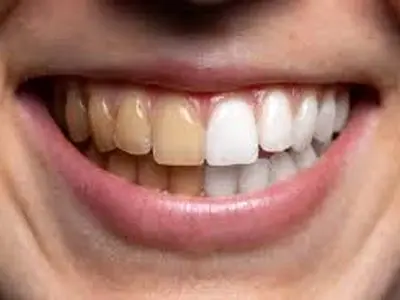 جرم گیری طبیعی دندان با کنجد