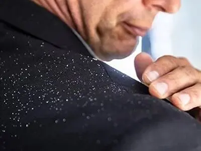همه چیز در مورد شوره سر 