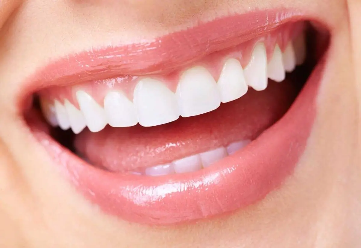 تفاوت کامپوزیت دندان و لمینت چیست؟