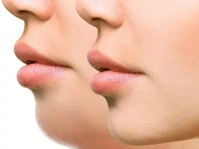 بهترین روش های از بین بردن غبغب بدون عمل جراحی